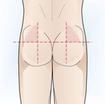 intramuscular part superior glutis
